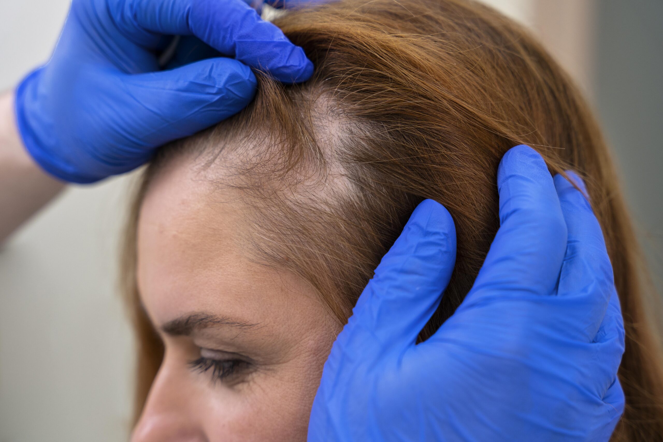 woman getting hair loss treatment clinic scaled