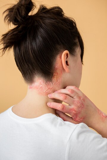 psoriasis eczema neck patient 23 2149329650